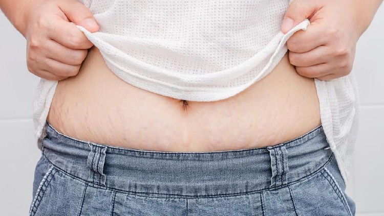 Jerawat dan stretch mark Kulit pun berubah saat Bunda menjalani masa kehamilan. Apa saja yang berbeda? Yuk lihat bersama.