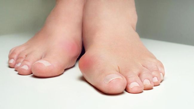 Cara penanganan yang tepat menghadapi bunion bisa diketahui melalui konsultasi langsung di Ortophedic Center Mayapada Hospital Bandung.