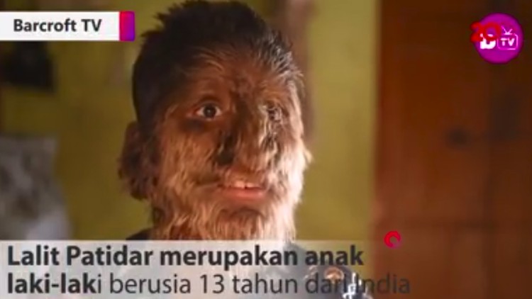Lalit Patidar, bocah yang dijuluki 'Werewolf' dari India tak malu dengan kondisinya. Hebatnya, ia juga bercita-cita untuk menjadi polisi.
