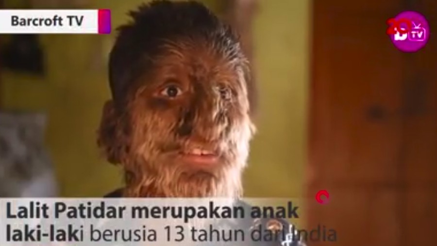 Kisah Bocah 'Werewolf', Tak Malu Meski Tubuh Dipenuhi Bulu