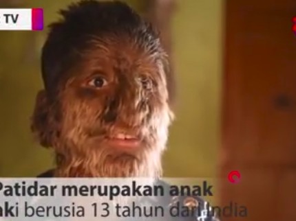 Kisah Bocah 'Werewolf', Tak Malu Meski Tubuh Dipenuhi Bulu