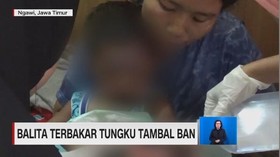 Balita Terbakar Tungku Ban