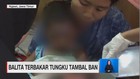 Balita Terbakar Tungku Ban