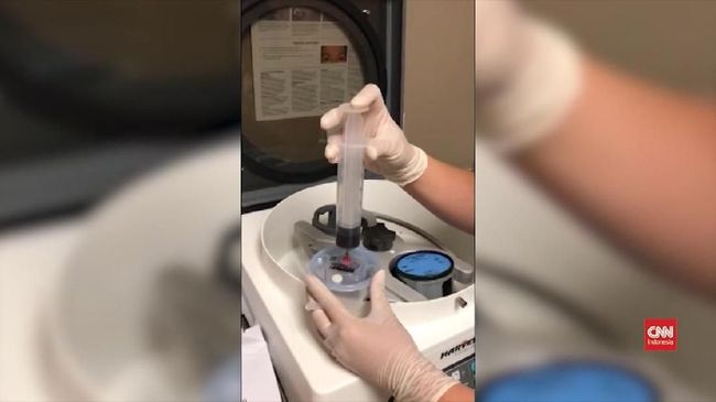 CDC melaporkan tiga wanita di New Mexico terinfeksi HIV setelah melakukan perawatan facial vampir di sebuah spa kecantikan tak berizin.