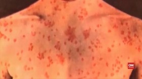VIDEO: Wabah Campak Hantui AS