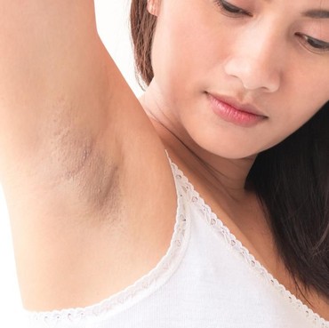 Inilah 5 Racikan Alami untuk Cerahkan Ketiak Hitam, Kamu Harus Coba!