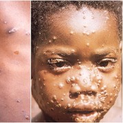 Cacar Monyet Mendadak Ramai Melanda Banyak Negara, Ini Gejala dan Cara Penularannya!