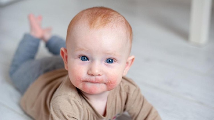 Bayi berusia 6 bulan pernah terkena eksem setelah diajak orang tuanya ke pesta pernikahan.