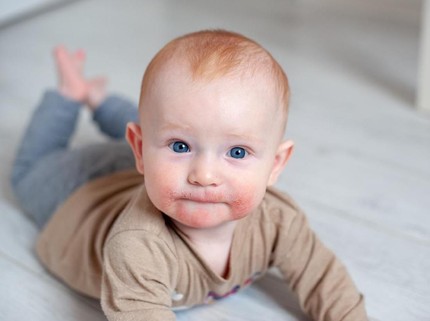 Kisah Bayi Kena Eksem Setelah Pipinya Disentuh Banyak Orang