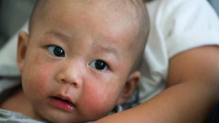 Biang Keringat Sampai Jerawat, Ini Lho Berbagai Masalah Kulit Bayi Kulit bayi tidak selalu semulus seperti yang ada di iklan TV.
