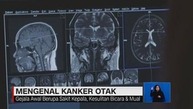 VIDEO: Mengenal Kanker Otak