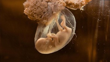 BAHAYA SINDROM ASPIRASI MEKONIUM PADA BAYI BARU LAHIR