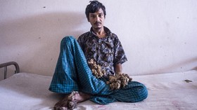 Sakit Tak Menahan, 'Manusia Pohon' Ingin Tangannya Diamputasi