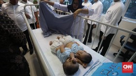 Bayi Kembar Adam-Malik Berhasil Dipisahkan Usai Operasi 5 Jam