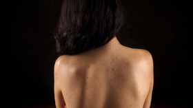 7 Cara Ampuh Atasi Jerawat Punggung