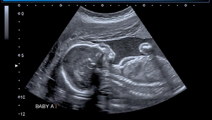Anatomy scan of twin gestation, monochorionic diamniotic. Fetal anatomy visualized with normal appearance 4 chamber heart, great artery views, head, brain, face, spine, neck, chest, abdominal wall, gastointestinal tract, kidneys, bladder, extremities and skeleton. Male fetus genetalia. No fetal anomalies were detected.