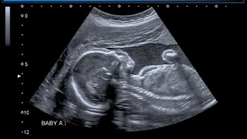 89 Gambar Usg 2 Dimensi Bayi Laki Laki Terlihat Keren