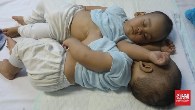 Dokter dari tim medis operasi pemisahan bayi kembar Adam dan Malik, menyatakan akan melakukan operasi pemisahan pada 23 Juli 2019. Hati kedua bayi itu menempel.