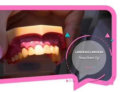 Begini Langkah-langkah Proses Veneer Gigi