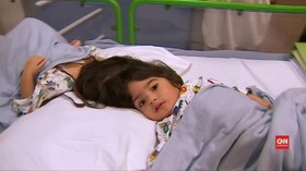 VIDEO: Cerita Sukses Pemisahan Kepala Bayi Kembar Siam