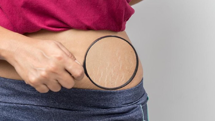 Women Show off the belly after birth. Stretch Marks on white background