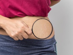 Perawatan Samarkan Stretch Marks, Wanita Alami Hal Ngeri: Jantungnya Meledak