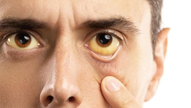 Hepatitis C sulit terdeteksi. Kenali gejala awal hepatitis C berikut untuk mendeteksinya sejak dini.