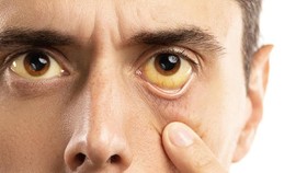 Kenali Gejala Hepatitis C Sejak Dini