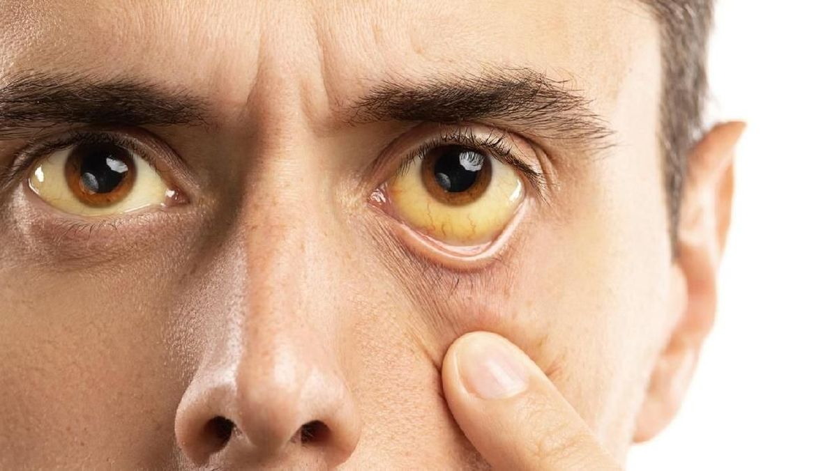 7 Penyakit Ini Jadi Penyebab Mata yang Menguning