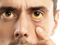 Kenali Gejala Hepatitis C Sejak Dini