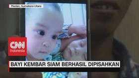 VIDEO: Bayi Kembar Siam Berhasil Dipisahkan