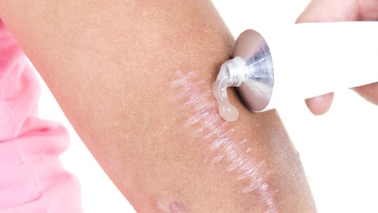 3 Jenis Perawatan Keloid yang Bunda Perlu Tahu Luka pada kulit bisa memicu keloid. Lantas, perawatan apa yang diberikan pada orang dengan keloid?