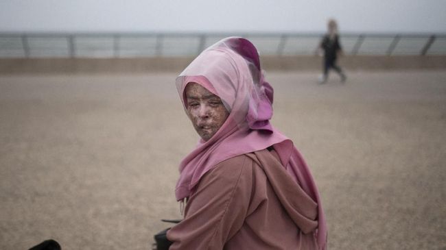 Xeroderma pigmentosum (XP) adalah sebuah kelainan genetik langka yang membuat seseorang 'alergi,' dengan sinar matahari.