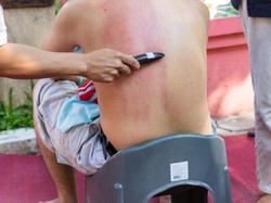 Video: Khasiat dan Efek Bahaya dari Kerokan