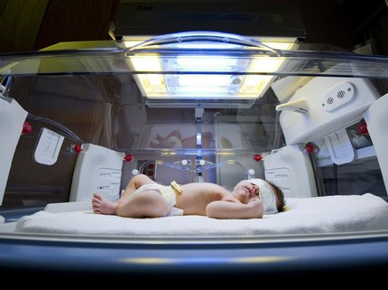 Bilirubin Tinggi Penyebab Bayi Kuning di Minggu Awal Kelahirannya