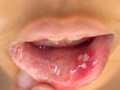 5 Obat Alami Panas Dalam