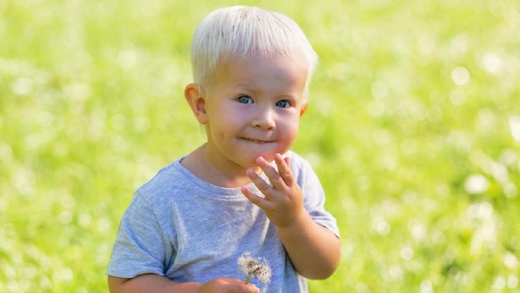 Albino atau albinisme merupakan kelainan genetik yang dibagi menjadi beberapa jenis. Apa saja?