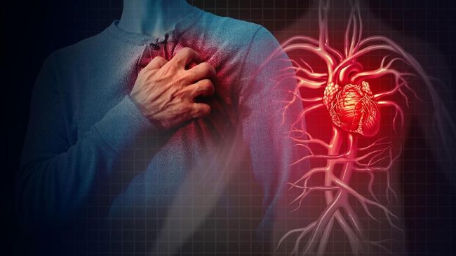 Understanding Angina: A Warning Sign of Heart Attacks | CNN Indonesia