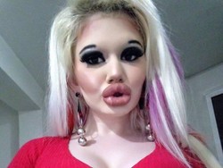 Wanita dengan Bibir Kebanyakan Filler Ini Abaikan Peringatan Dokter