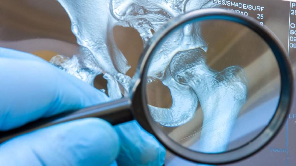 7 Pantangan Makanan Penderita Asam Urat yang Perlu Dihindari