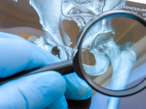 7 Pantangan Makanan Penderita Asam Urat yang Perlu Dihindari