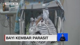 VIDEO: Bayi Kembar Parasit