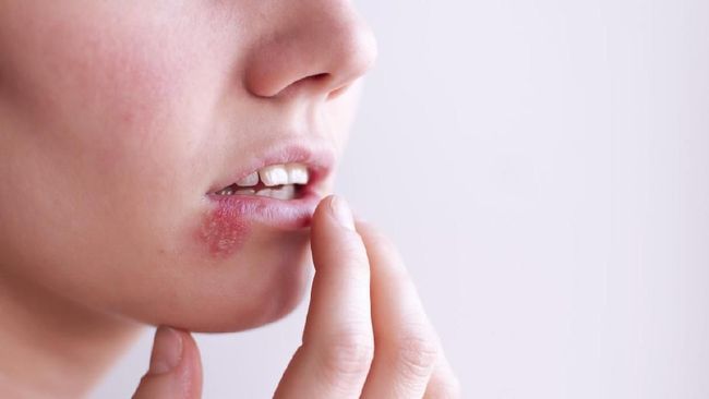Herpes zoster sering juga disebut sebagai cacar api atau cacar ular. Berikut penyebab, gejala, pengobatan, dan pencegahan herpes zoster.