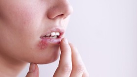 Penyebab dan Cara Mencegah Penyakit Herpes