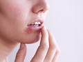 Herpes Zoster: Penyebab, Gejala, dan Pencegahan