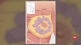 VIDEO: Kenali Kanker Payudara yang Umum Menyerang Wanita