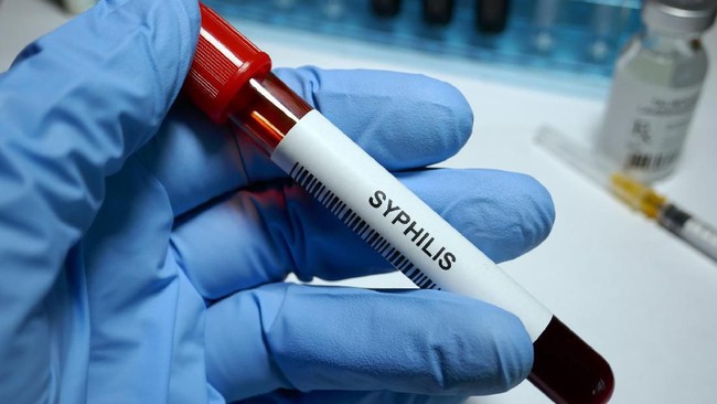 10 Wilayah Indonesia Ini Alami Peningkatan Kasus Sifilis, Papua Nomor 1