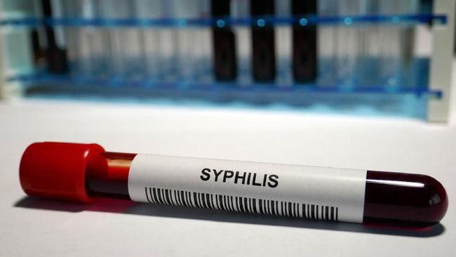 Sifilis menjadi salah satu penyakit menular seksual yang paling umum. Pertanyaannya, apakah penyakit sifilis bisa sembuh?
