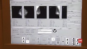VIDEO: Pencegahan dan Deteksi Awal Kanker Payudara
