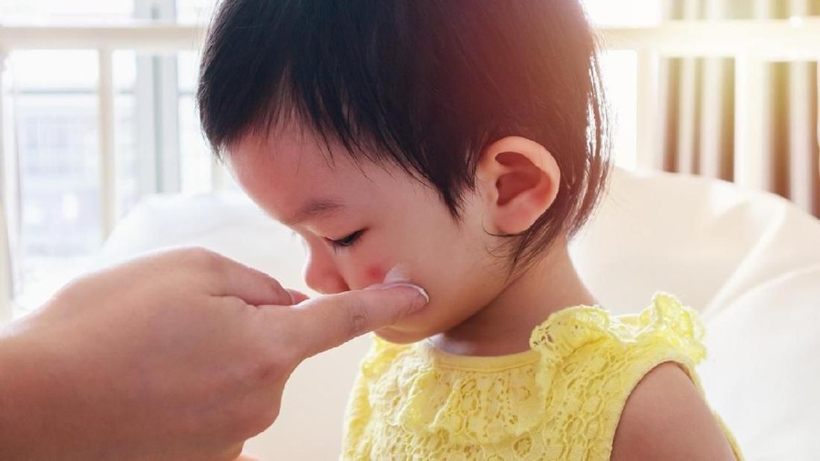  Bisul  pada Anak Penyebab  dan Cara Mengobatinya